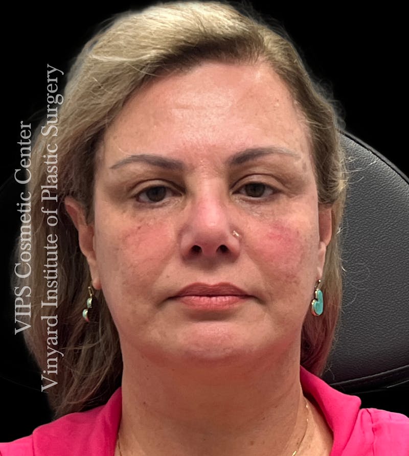 BOTOX® Before & After Gallery - Patient 155325 - Image 1