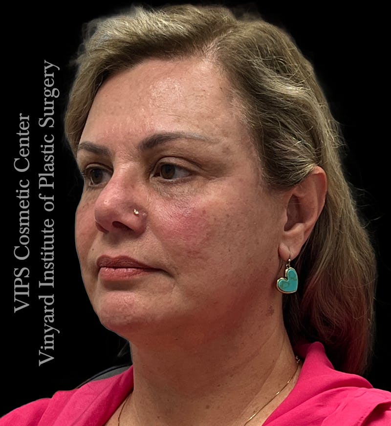 BOTOX® Before & After Gallery - Patient 155325 - Image 3