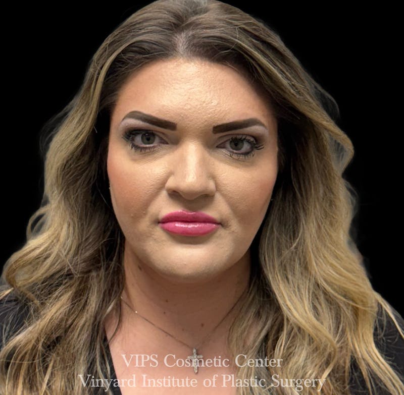 Lip Fillers Before & After Gallery - Patient 266487 - Image 2