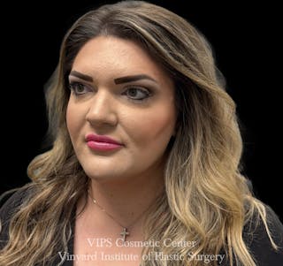 Lip Fillers Before & After Gallery - Patient 266487 - Image 6