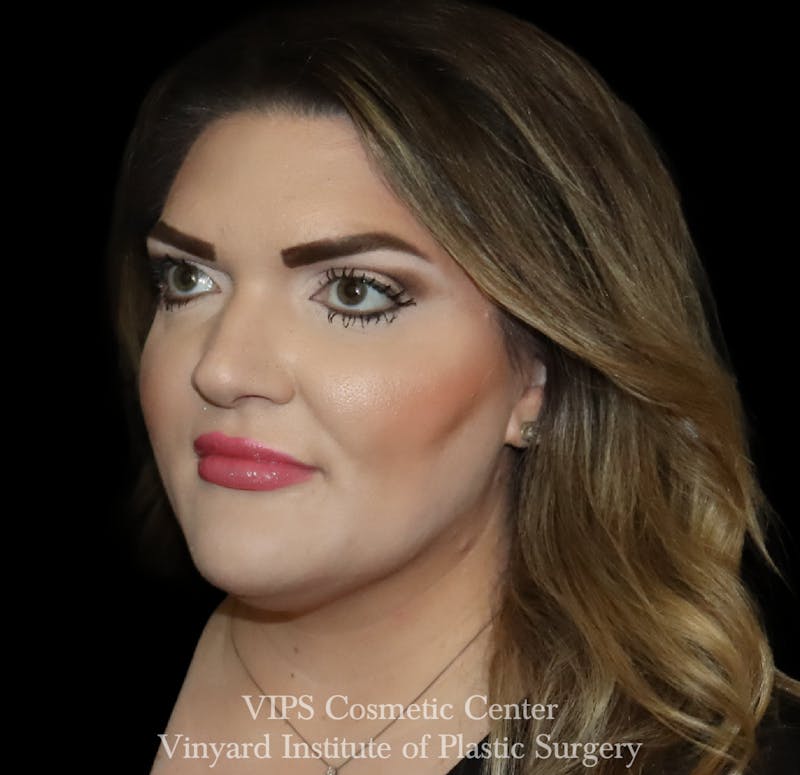 Lip Fillers Before & After Gallery - Patient 266487 - Image 4