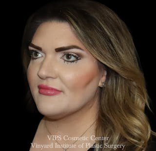 Lip Fillers Before & After Gallery - Patient 266487 - Image 4