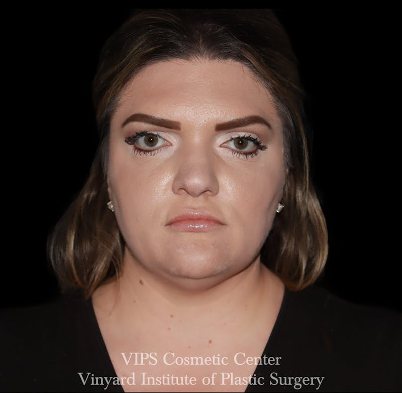 Lip Fillers Before & After Gallery - Patient 266487 - Image 1