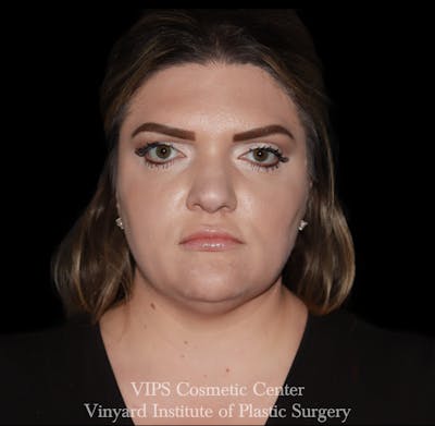 Lip Fillers Before & After Gallery - Patient 266487 - Image 1