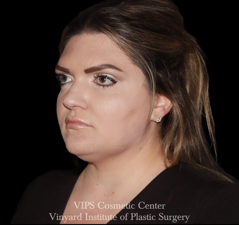 Lip Fillers Before & After Gallery - Patient 266487 - Image 5