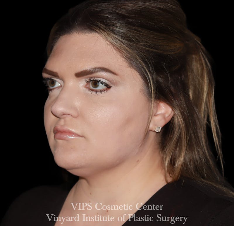 Lip Fillers Before & After Gallery - Patient 266487 - Image 3