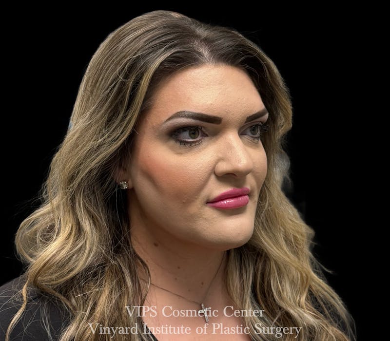 Lip Fillers Before & After Gallery - Patient 266487 - Image 8