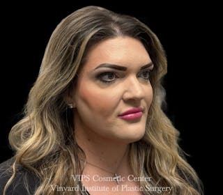 Lip Fillers Before & After Gallery - Patient 266487 - Image 8