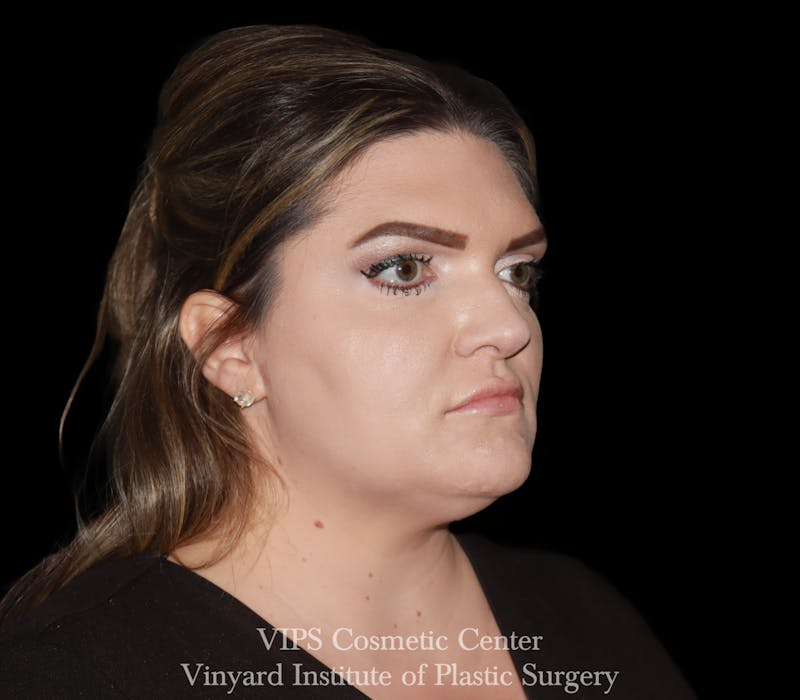 Lip Fillers Before & After Gallery - Patient 266487 - Image 7