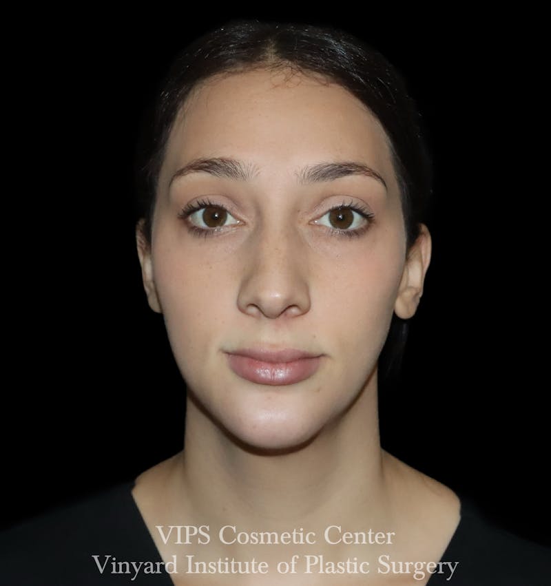 Lip Fillers Before & After Gallery - Patient 288835 - Image 2