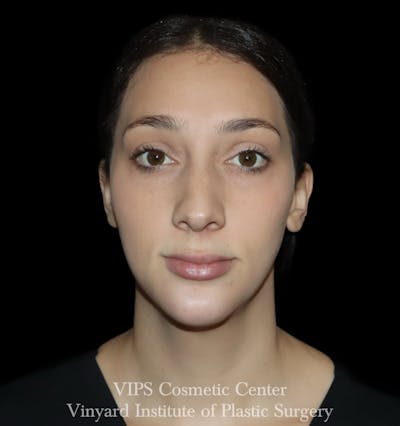 Lip Fillers Before & After Gallery - Patient 288835 - Image 2