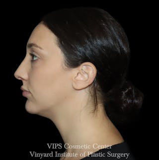 Lip Fillers Before & After Gallery - Patient 288835 - Image 6