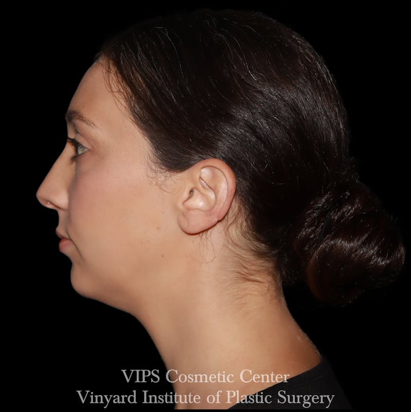 Lip Fillers Before & After Gallery - Patient 288835 - Image 5