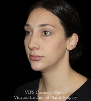Lip Fillers Before & After Gallery - Patient 288835 - Image 4