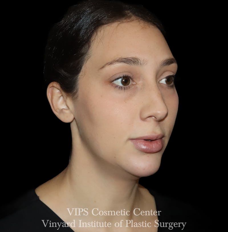 Lip Fillers Before & After Gallery - Patient 288835 - Image 8
