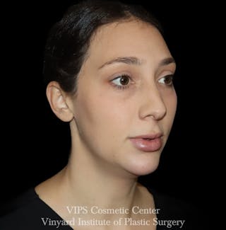 Lip Fillers Before & After Gallery - Patient 288835 - Image 8