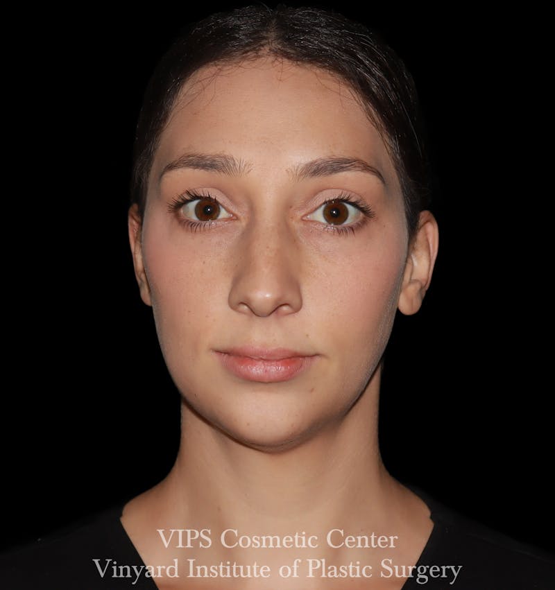 Lip Fillers Before & After Gallery - Patient 288835 - Image 1