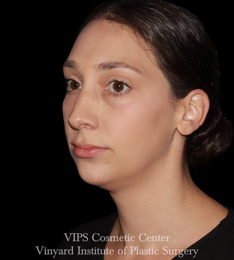 Lip Fillers Before & After Gallery - Patient 288835 - Image 3