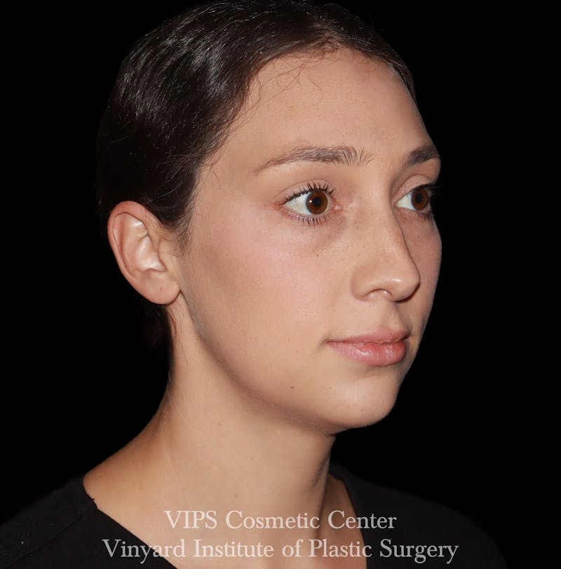 Lip Fillers Before & After Gallery - Patient 288835 - Image 7