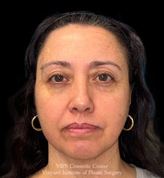 Laser Skin Resurfacing Before & After Gallery - Patient 308171 - Image 2