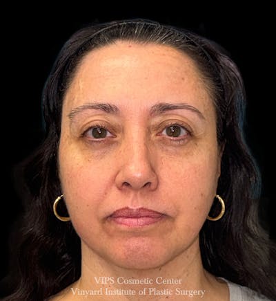 Laser Skin Resurfacing Before & After Gallery - Patient 308171 - Image 2