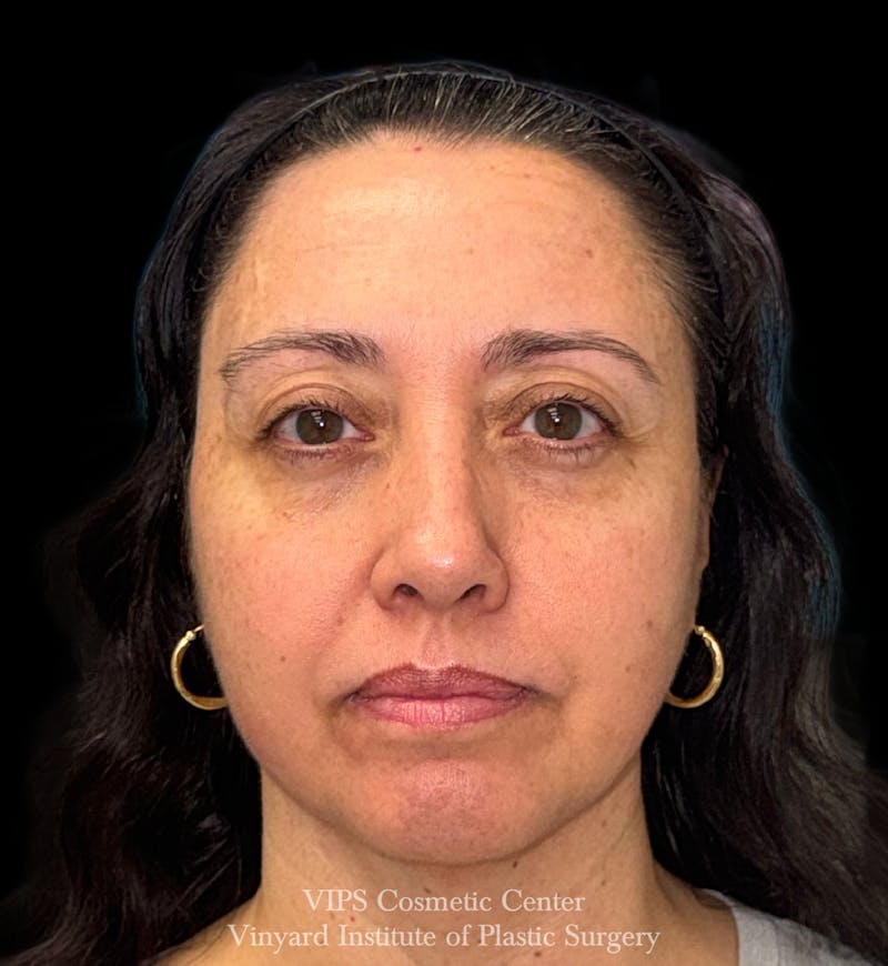 Laser Skin Resurfacing Before & After Gallery - Patient 308171 - Image 2