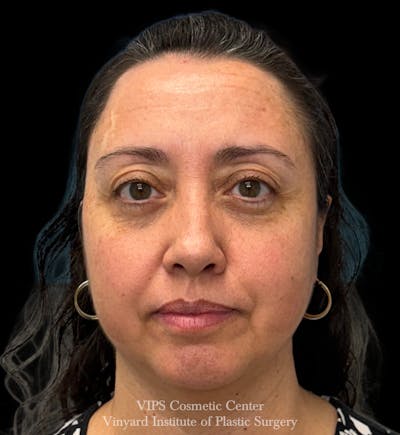 Laser Skin Resurfacing Before & After Gallery - Patient 308171 - Image 1