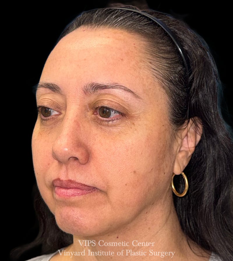 Laser Skin Resurfacing Before & After Gallery - Patient 308171 - Image 4