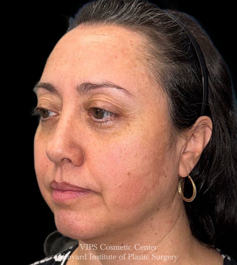 Laser Skin Resurfacing Before & After Gallery - Patient 308171 - Image 3