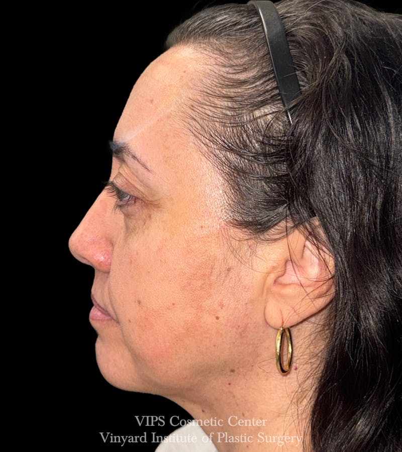 Laser Skin Resurfacing Before & After Gallery - Patient 308171 - Image 6