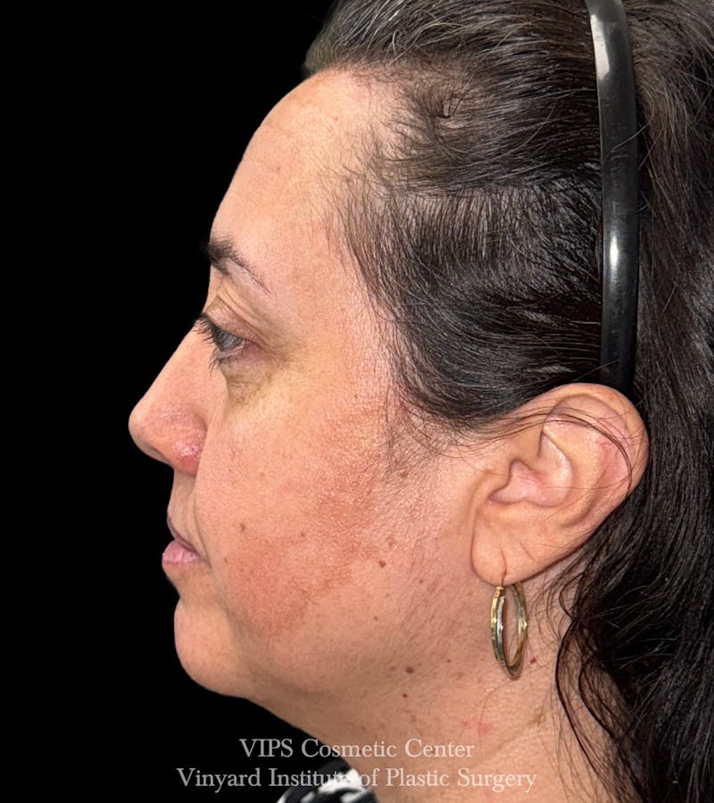 Laser Skin Resurfacing Before & After Gallery - Patient 308171 - Image 5