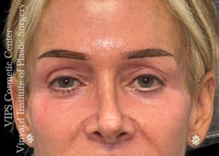 Laser Skin Resurfacing Before & After Gallery - Patient 330116 - Image 2