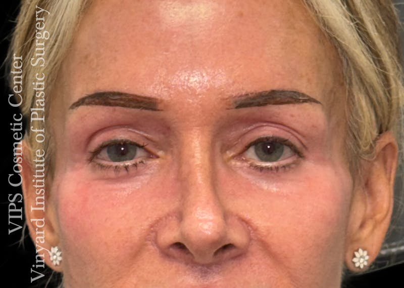 Laser Skin Resurfacing Before & After Gallery - Patient 330116 - Image 2