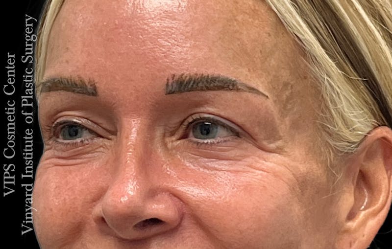 Laser Skin Resurfacing Before & After Gallery - Patient 330116 - Image 5