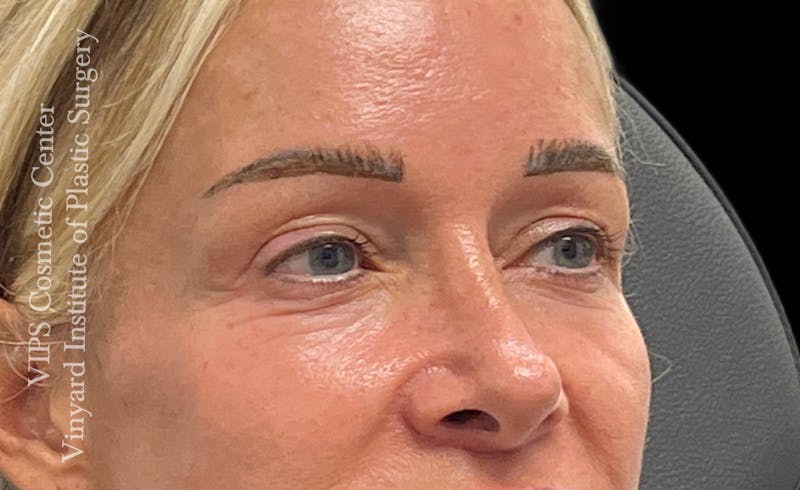 Laser Skin Resurfacing Before & After Gallery - Patient 330116 - Image 3