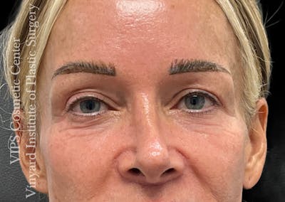 Laser Skin Resurfacing Before & After Gallery - Patient 330116 - Image 1