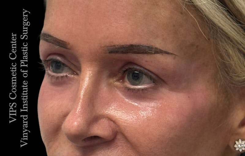 Laser Skin Resurfacing Before & After Gallery - Patient 330116 - Image 6