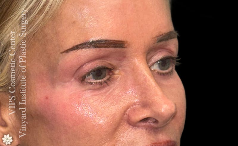 Laser Skin Resurfacing Before & After Gallery - Patient 330116 - Image 4