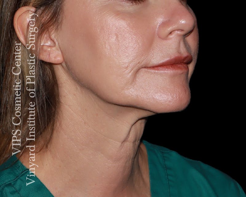 Morpheus8 RF Microneedling Before & After Gallery - Patient 206275 - Image 4
