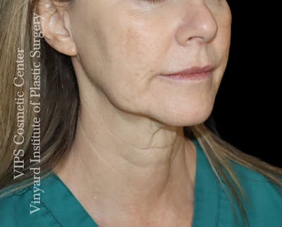 Morpheus8 RF Microneedling Before & After Gallery - Patient 748132 - Image 1