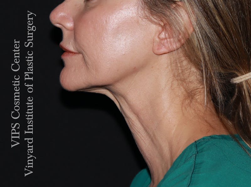 Morpheus8 RF Microneedling Before & After Gallery - Patient 206275 - Image 2