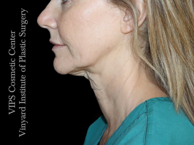 Morpheus8 RF Microneedling Before & After Gallery - Patient 206275 - Image 1