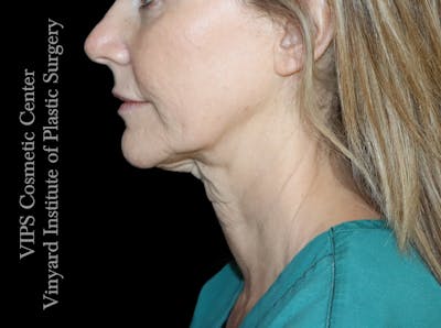 Morpheus8 RF Microneedling Before & After Gallery - Patient 206275 - Image 1