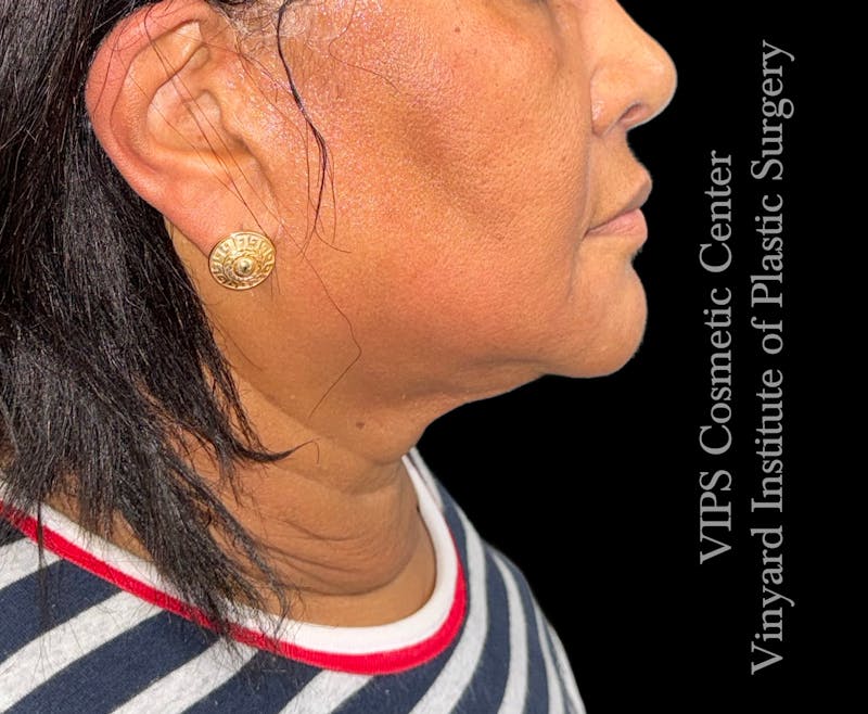 Morpheus8 RF Microneedling Before & After Gallery - Patient 112174 - Image 2