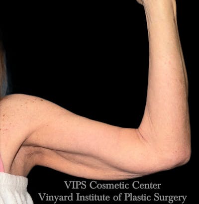 Morpheus8 BODY RF Microneedling Before & After Gallery - Patient 285942 - Image 1