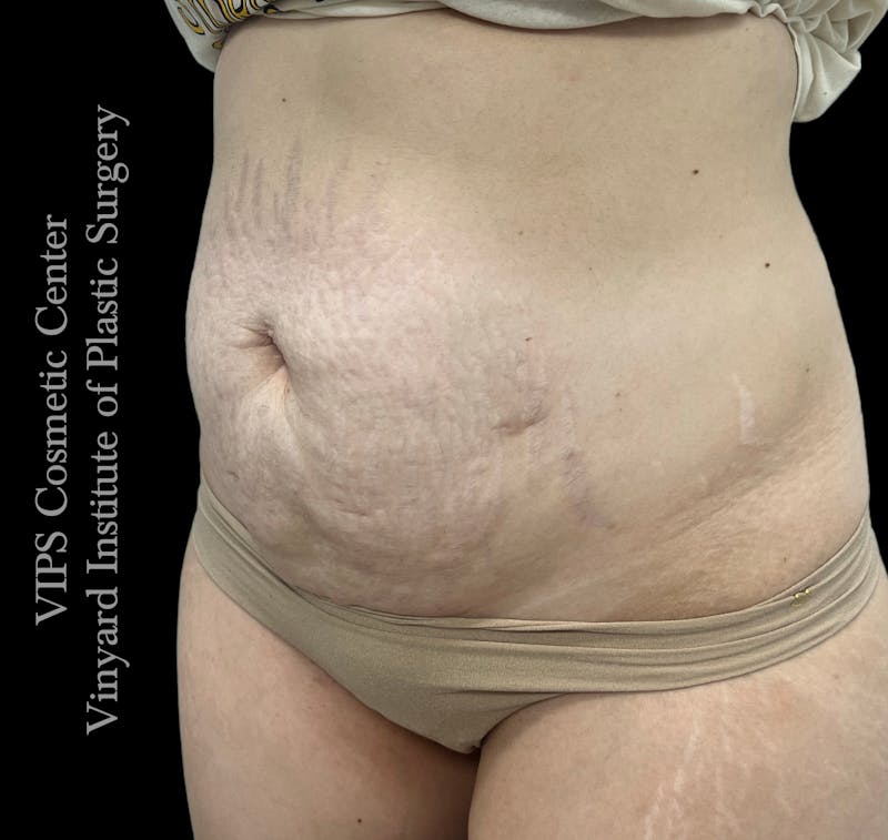 Morpheus8 BODY RF Microneedling Before & After Gallery - Patient 173485 - Image 3