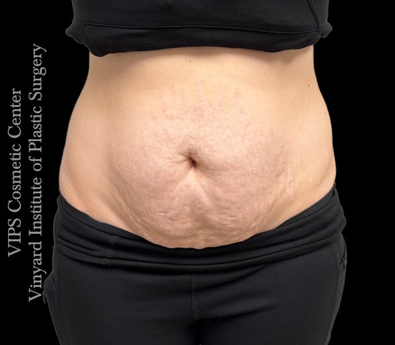 Morpheus8 BODY RF Microneedling Before & After Gallery - Patient 173485 - Image 2