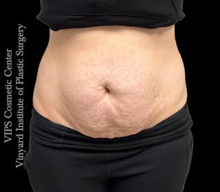 Morpheus8 BODY RF Microneedling Before & After Gallery - Patient 173485 - Image 2