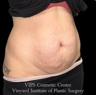 Morpheus8 BODY RF Microneedling Before & After Gallery - Patient 173485 - Image 6