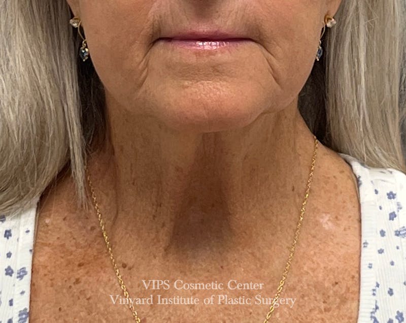 Deep CO2 Laser Skin Resurfacing Before & After Gallery - Patient 377514 - Image 2